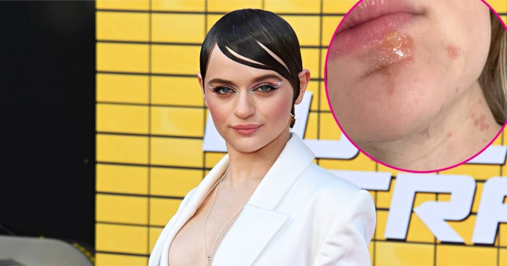 Joey King Reveals Cooking Injury to Her Face