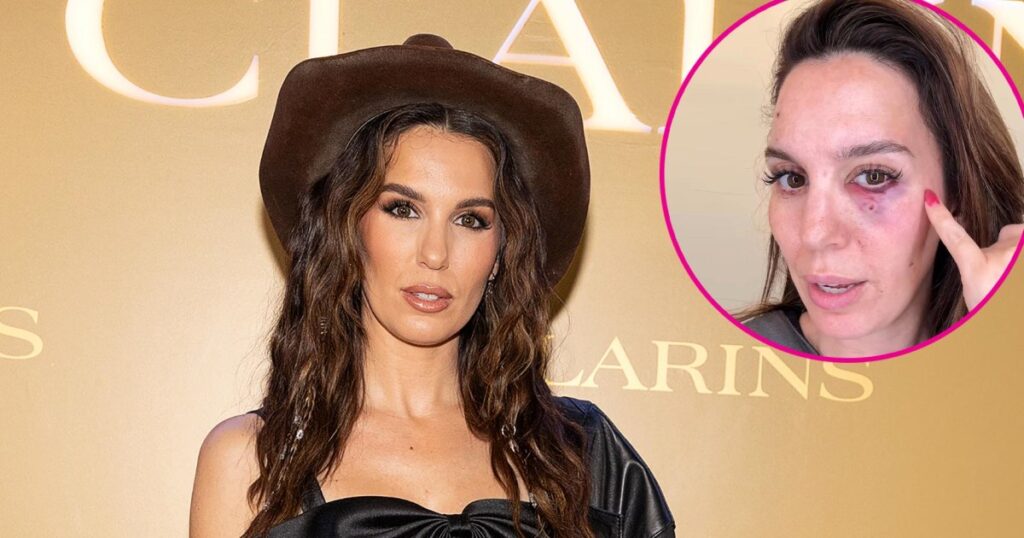 Christy Carlson Romano Allegedly Shot in the Eye on Husband’s Birthday