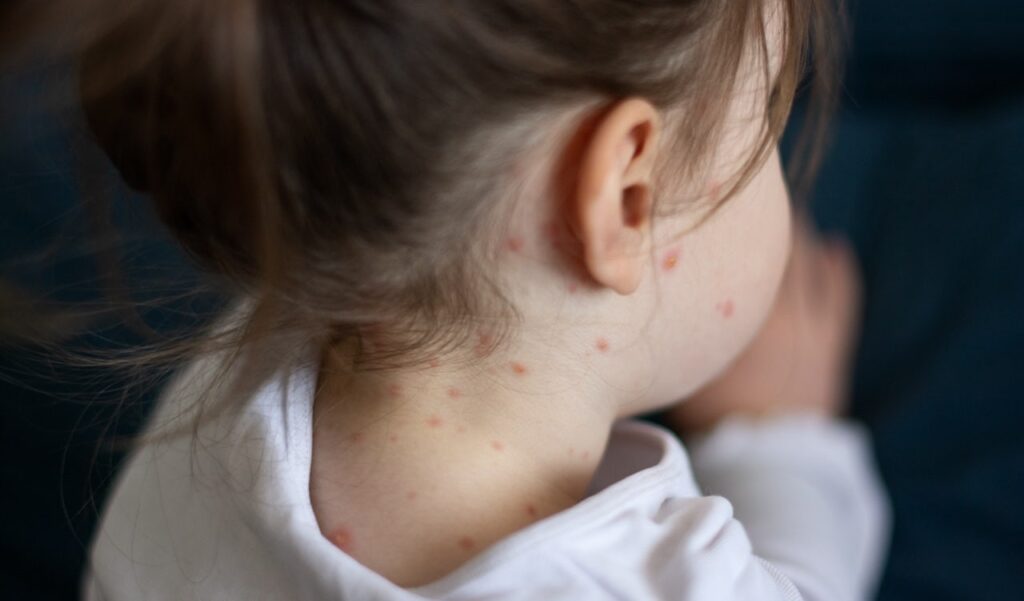 Measles cases continue to spread in multiple states following child’s death