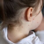 Measles cases continue to spread in multiple states following child’s death