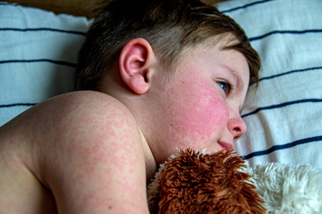 First measles death reported in West Texas amid growing outbreak