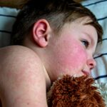 First measles death reported in West Texas amid growing outbreak