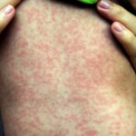 Measles Rash