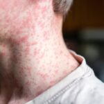 Measles Rash